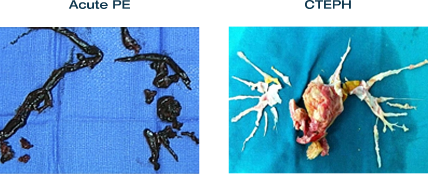 Images of pulmonary emboli in Acute PE and CTEPH